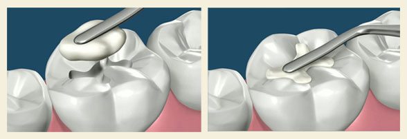 dental composite filling illustration